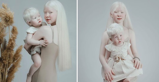 Albino sisters born 12 years apart