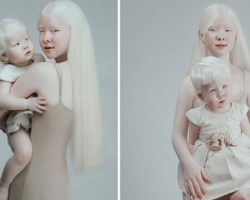 Albino sisters born 12 years apart