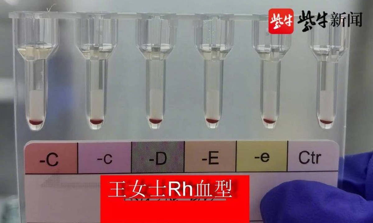 TWO PERSONS WITH RAREST ‘GOLDEN BLOOD’ FOUND IN EAST CHINA, RAISING GLOBAL NUMBER TO NEARLY 50
https://www.rhesusnegative.net/staynegative/77b41bd7-50d9-4db2-bd4b-16029aac099a-3/