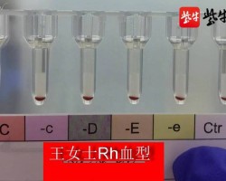 TWO PERSONS WITH RAREST ‘GOLDEN BLOOD’ FOUND IN EAST CHINA, RAISING GLOBAL NUMBER TO NEARLY 50
https://www.rhesusnegative.net/staynegative/77b41bd7-50d9-4db2-bd4b-16029aac099a-3/