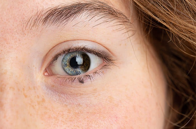 In sectoral heterochromia, sometimes referred to as partial heterochromia, areas of the same iris contain two completely different colors.