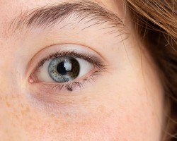 In sectoral heterochromia, sometimes referred to as partial heterochromia, areas of the same iris contain two completely different colors.