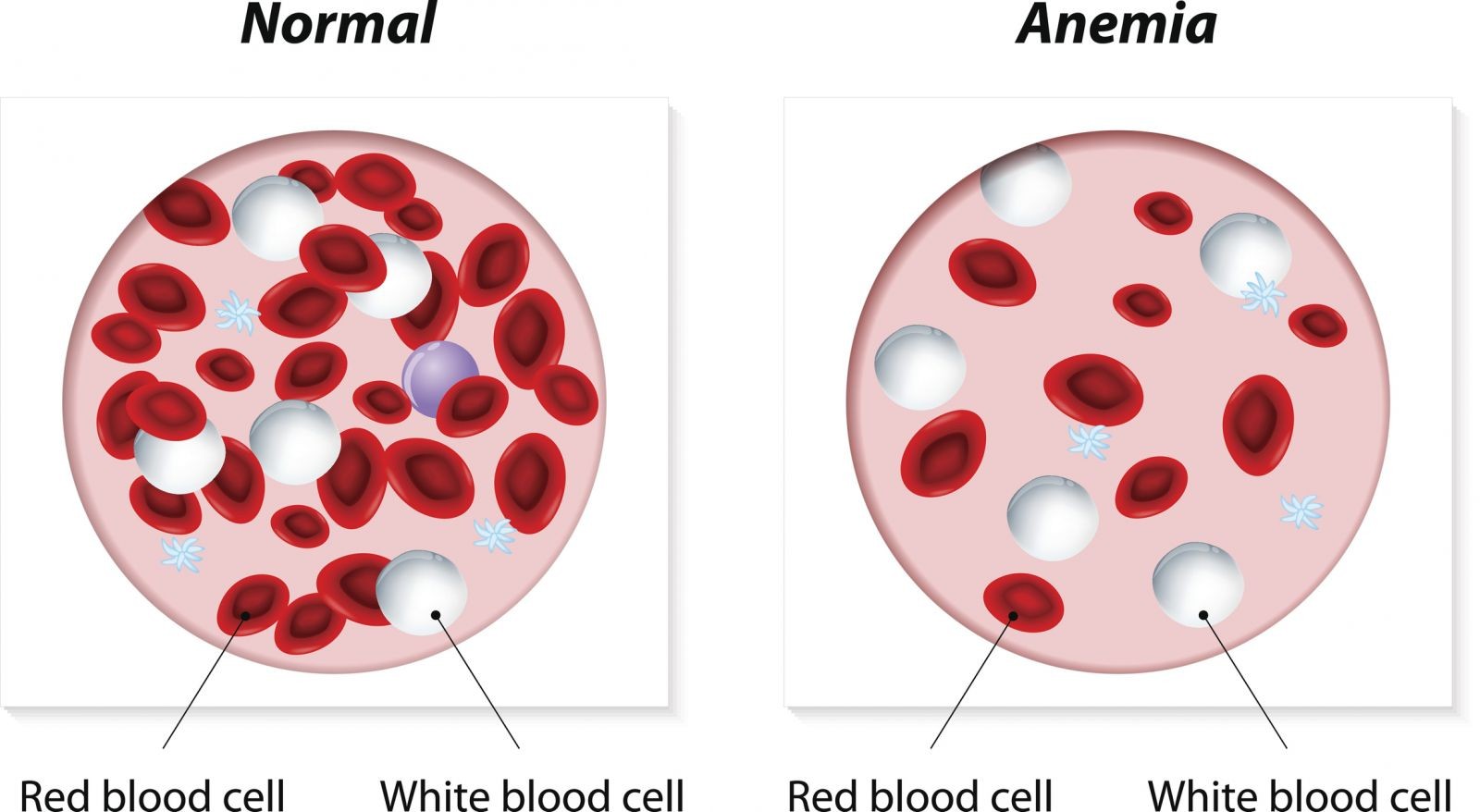 Anemia is a condition in which you lack enough healthy red blood cells to carry adequate oxygen to your body's tissues. Having anemia can make you feel tired and weak. There are many forms of anemia, each with its own cause.