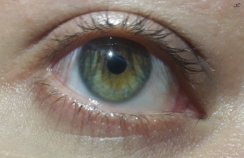 Central Heterochromia