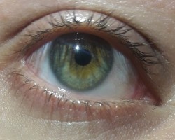 Central Heterochromia